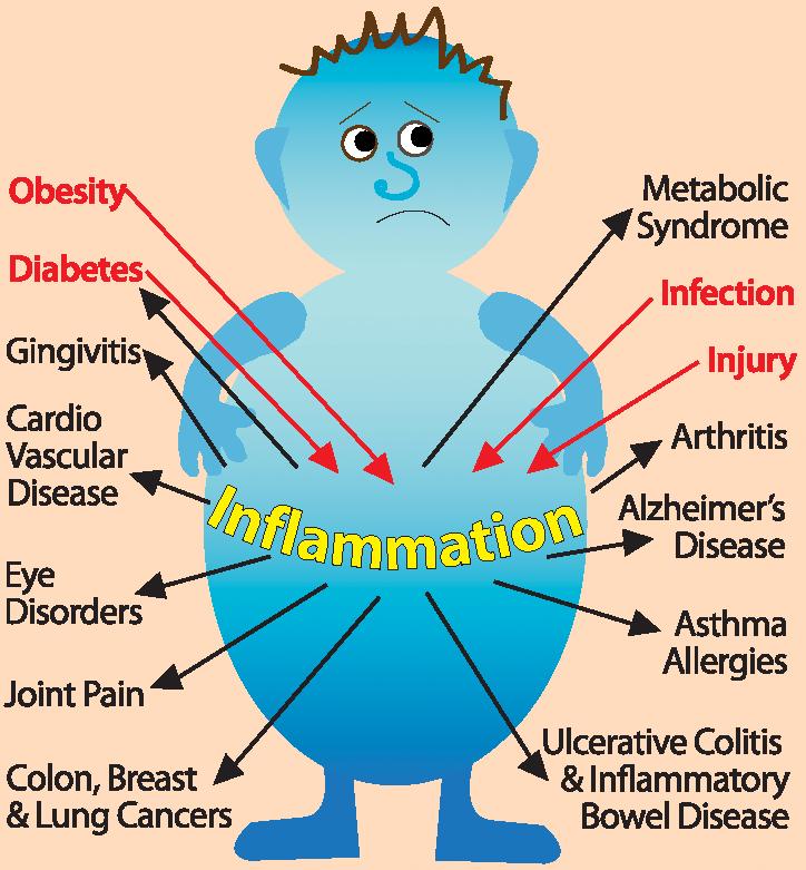 inflammation-myremedy