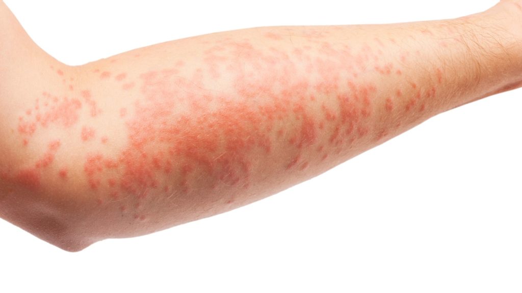 eczema