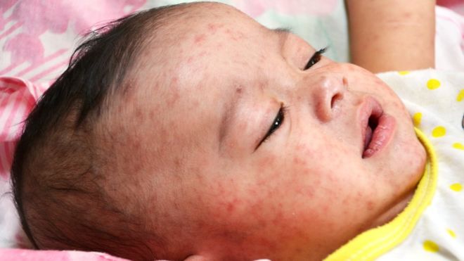 Read more about the article MEASLES INFORMATION